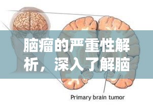 脑瘤的严重性解析，深入了解脑瘤危害与风险