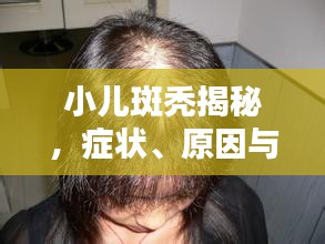 小儿斑秃揭秘，症状、原因与治疗方法一网打尽！